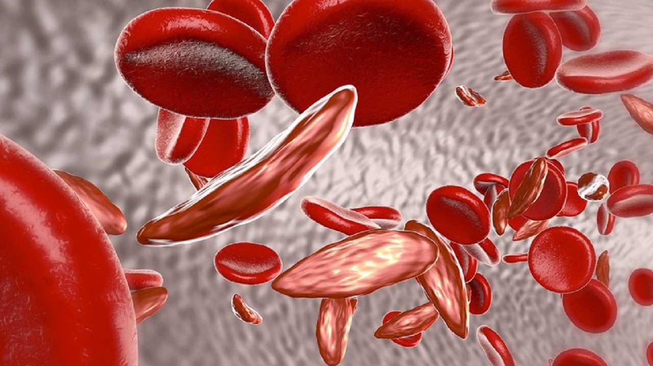 Bệnh thiếu máu di truyền ở trẻ em có thể chữa được không?