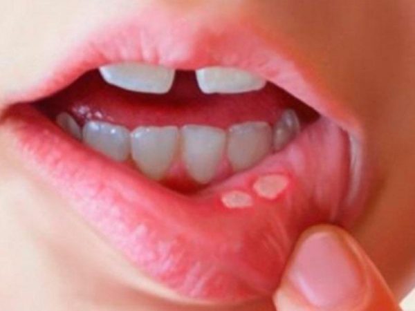 Tìm hiểu chung về chứng lở miệng