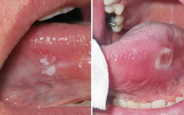 Triệu chứng của bệnh lở miệng
