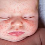 Trẻ bị nổi mẩn đỏ ở mặt là bị bệnh gì?