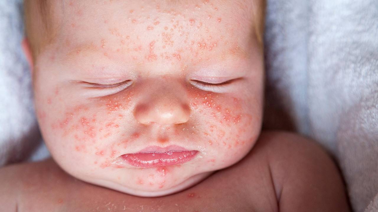 Trẻ bị nổi mẩn đỏ ở mặt là bị bệnh gì? | TCI Hospital