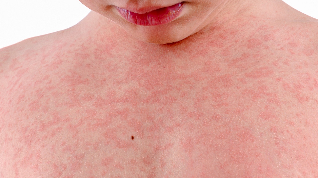 Trẻ bị nổi mẩn đỏ sau khi hết sốt có thể là dấu hiệu của bệnh gì?