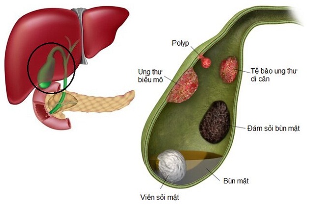 Túi mật có polyp: nguyên nhân, biến chứng và hướng điều trị