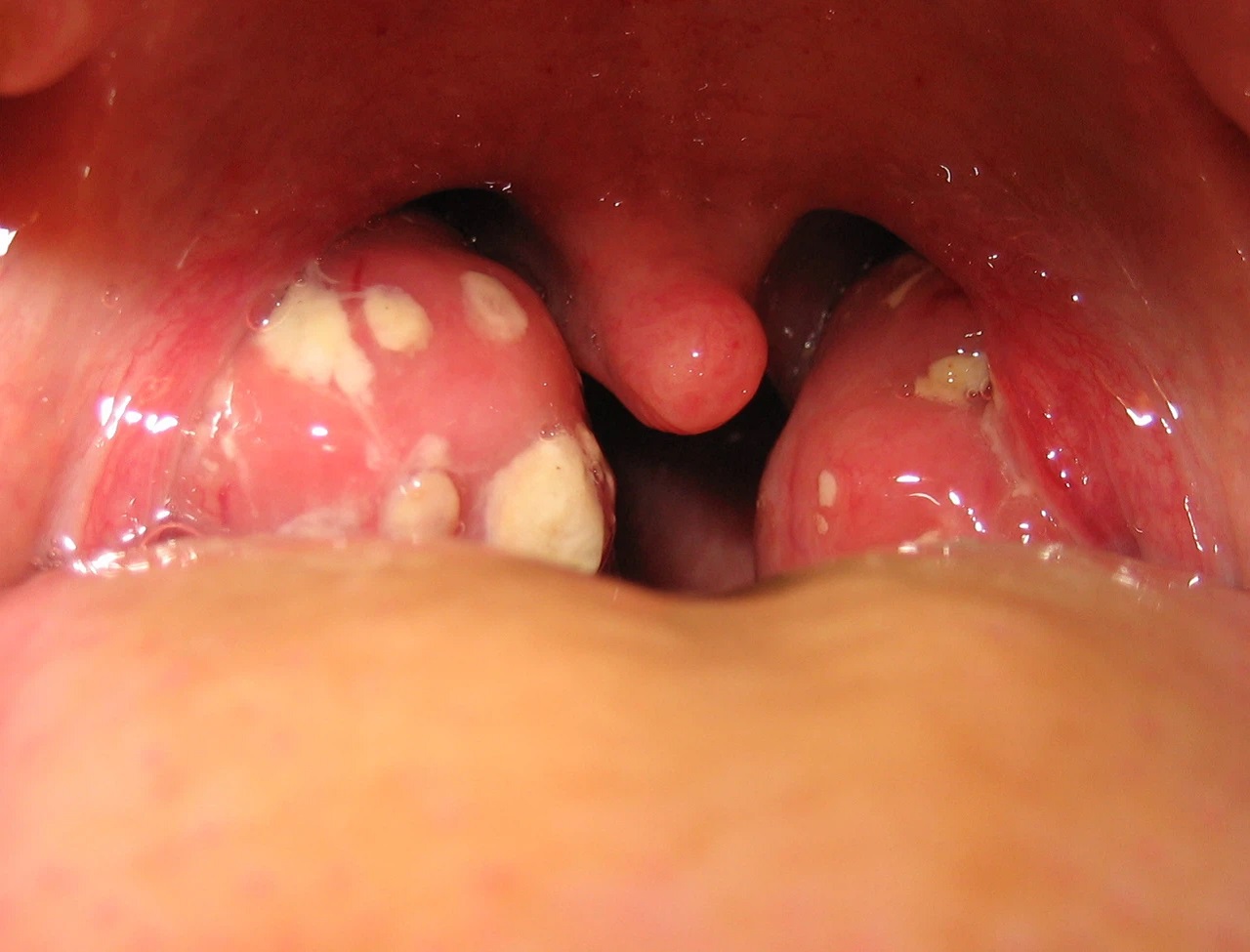 Dinh dưỡng trong Tai Mũi Họng cùng Dược sỹ Phương Purple - 🌵1. Viêm amidan  đáy lưỡi là gì? 💊Amidan là tổ chức hạch bạch huyết có tác dụng đáp ứng miễn