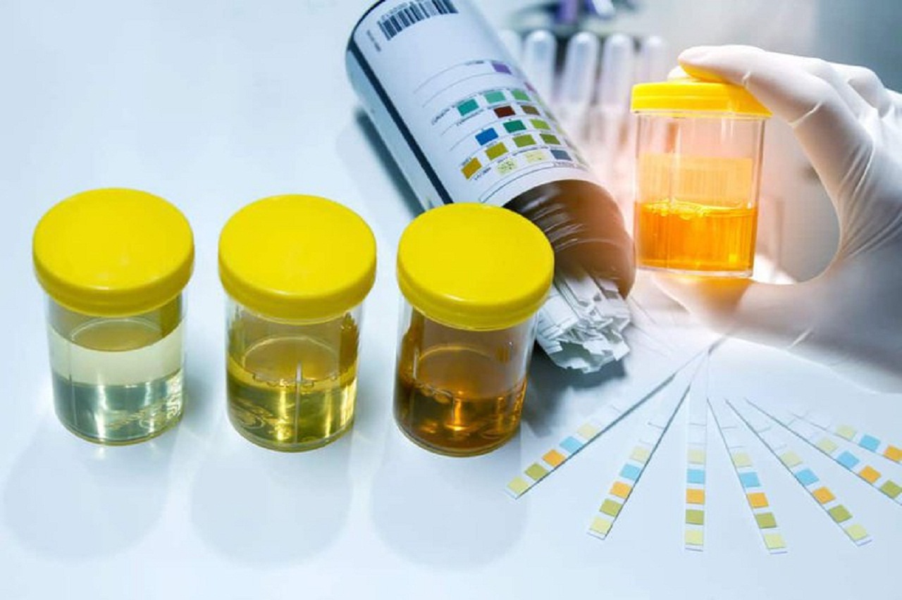 Các phương pháp xét nghiệm viêm đường tiết niệu ngoài xét nghiệm nước tiểu là gì?