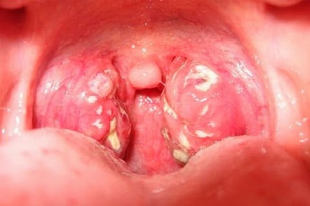 Amidan sưng to, đỏ tấy, xuất hiện nhiều đốm trắng ở khu vực họng là một trong những triệu chứng hay gặp khi mắc bệnh