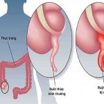 Viêm phúc mạc ruột thừa: triệu chứng, chẩn đoán và điều trị