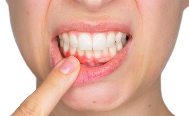 Vi khuẩn xâm nhập từ lỗ sâu răng tạo điều kiện cho chất có độc tính tấn công các mô xung quanh cuống răng.