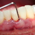 Viêm quanh cuống răng: 3 điều cần chú ý