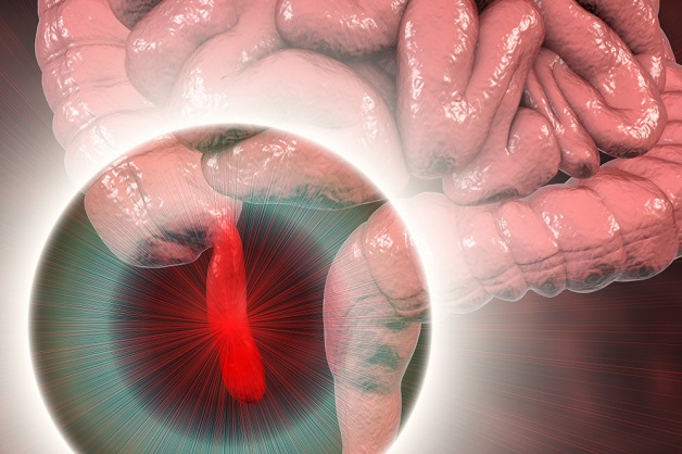 Viêm ruột thừa gây ra những biến chứng nguy hiểm nếu không kịp thời điều trị