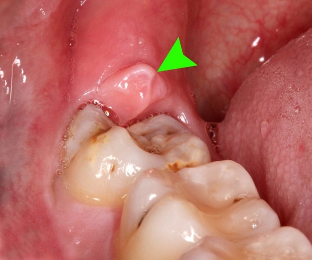 Viêm lợi trùm là hiện tượng nướu trong cùng bị sưng to, trùm lên bề mặt răng bên cạnh