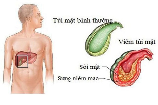 Viêm túi mật bệnh học: nguyên nhân, triệu chứng và cách điều trị