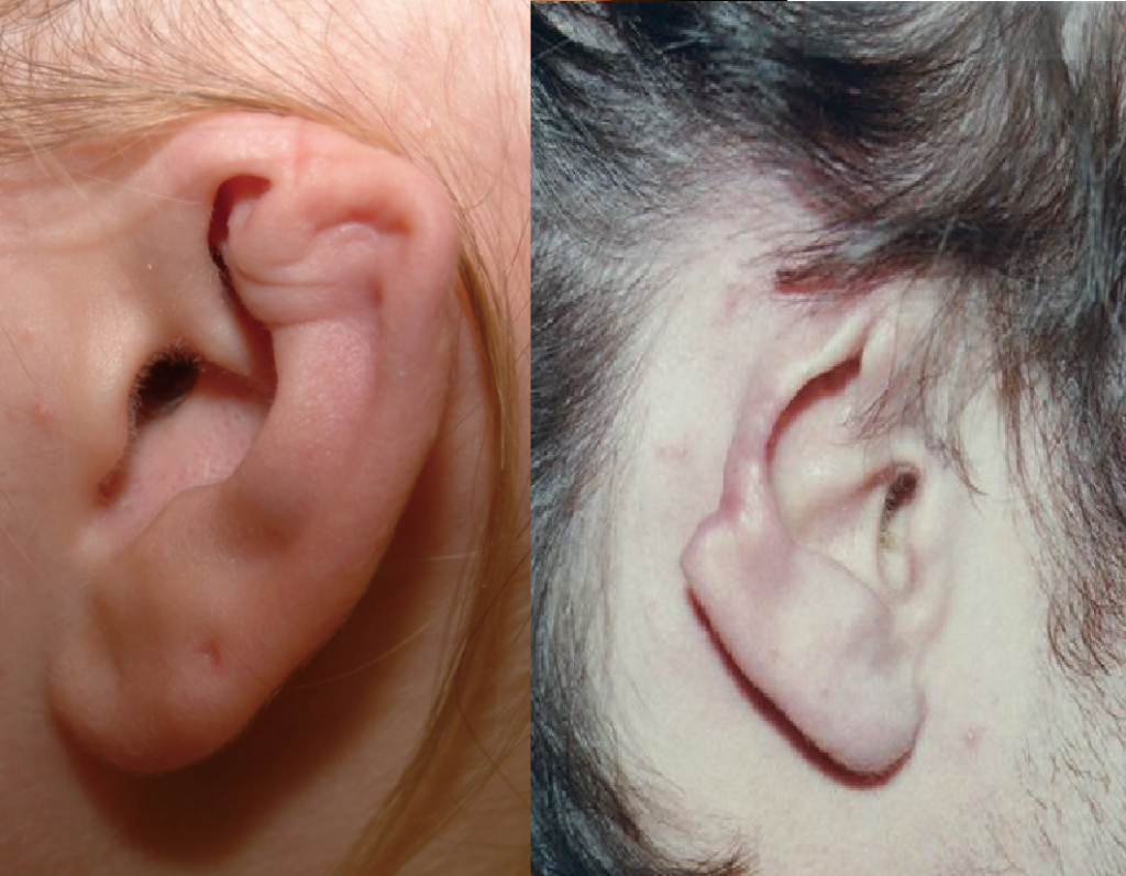 Biến chứng sau viêm màng sụn tai không được điều trị