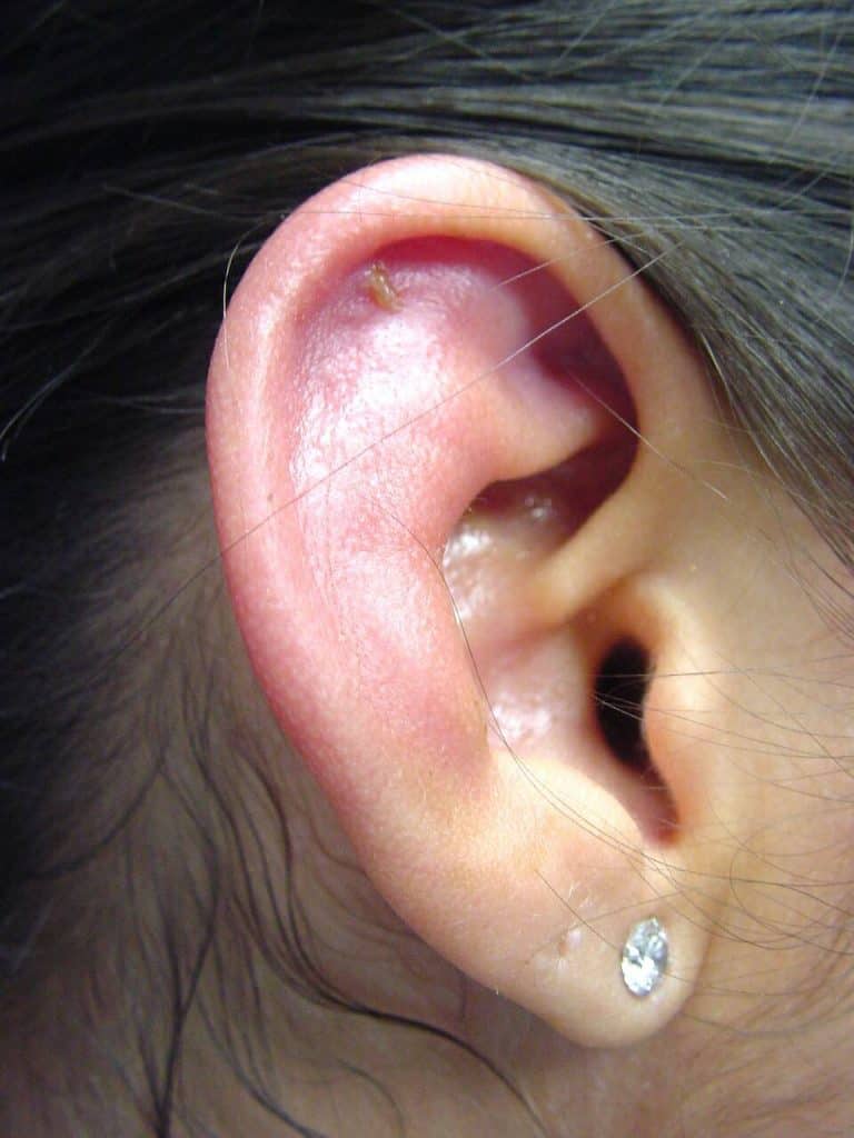 Hình ảnh viêm vành tai ở trẻ em