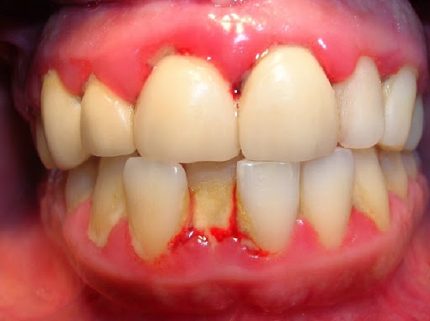 Viêm quanh răng là hiện tượng chân răng bị tổn thương do có sự trú ngụ của vi khuẩn