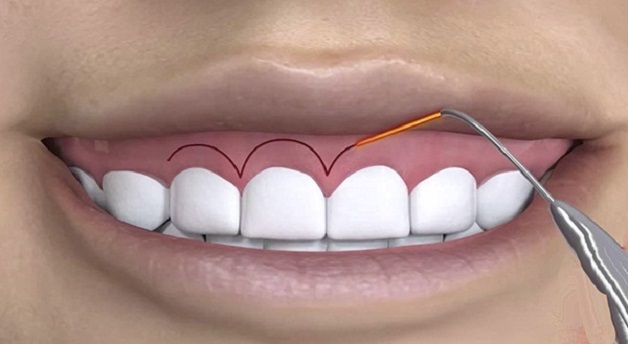 Phẫu thuật lật vạt điều trị viêm quanh răng