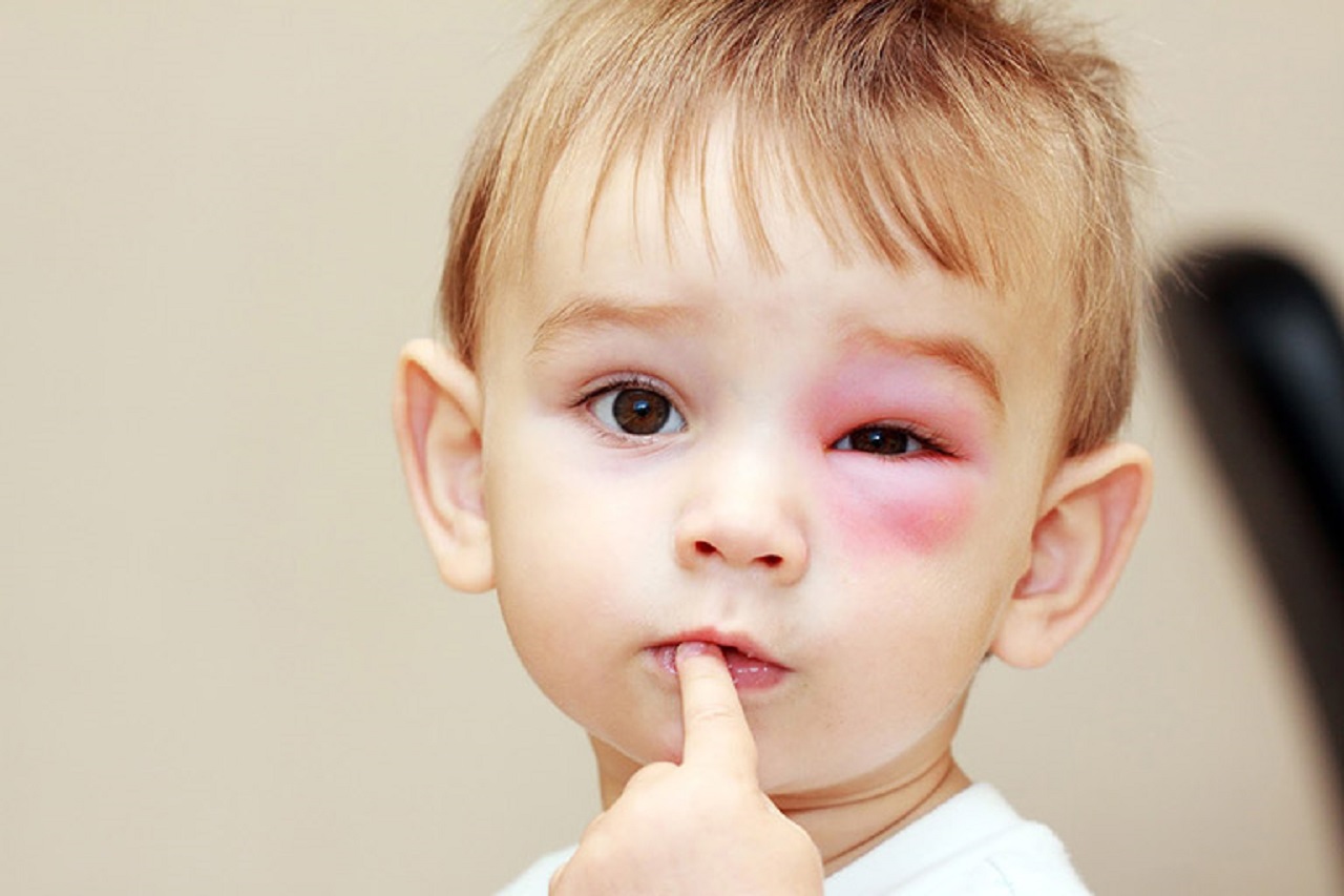 Điều gì làm bé bị nổi chấm đỏ quanh mắt khiến bé khó chịu?
