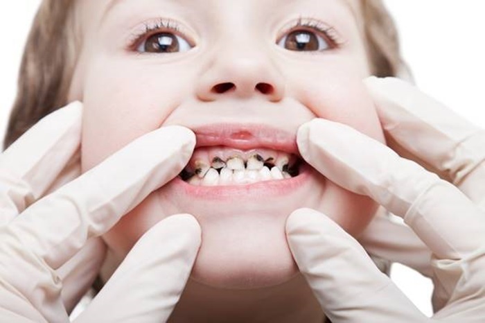 Khám và điều trị các bệnh lý răng ở trẻ em | TCI Hospital