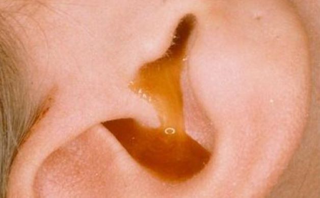 Bị nấm tai ngoài có dấu hiệu như thế nào?