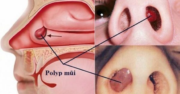 polyp ở mũi
