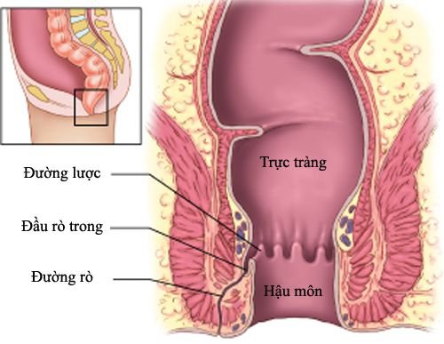 Bệnh rò ở hậu môn nghiêm trọng như thế nào?