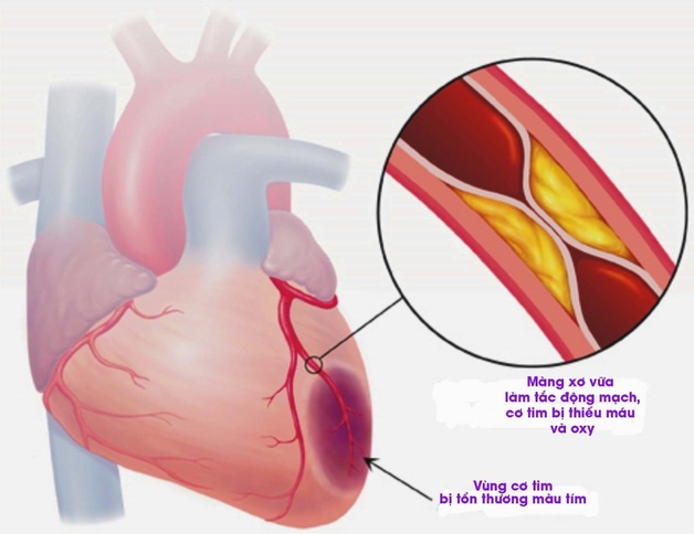 Bệnh hở van tim 3 lá 1/4 có nguy hiểm không? | TCI Hospital