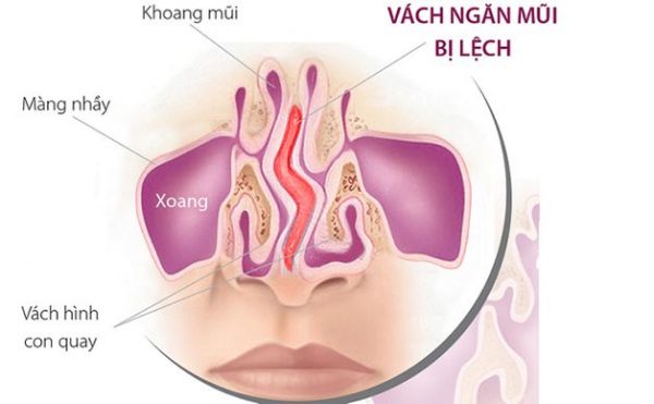 Bị lệch vách ngăn mũi có cần phải phẫu thuật không? | TCI Hospital