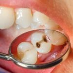 Nguyên nhân và cách chữa sâu răng cho trẻ 2 tuổi