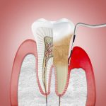 “Bỏ túi” những cách chữa viêm nha chu răng hiệu quả 