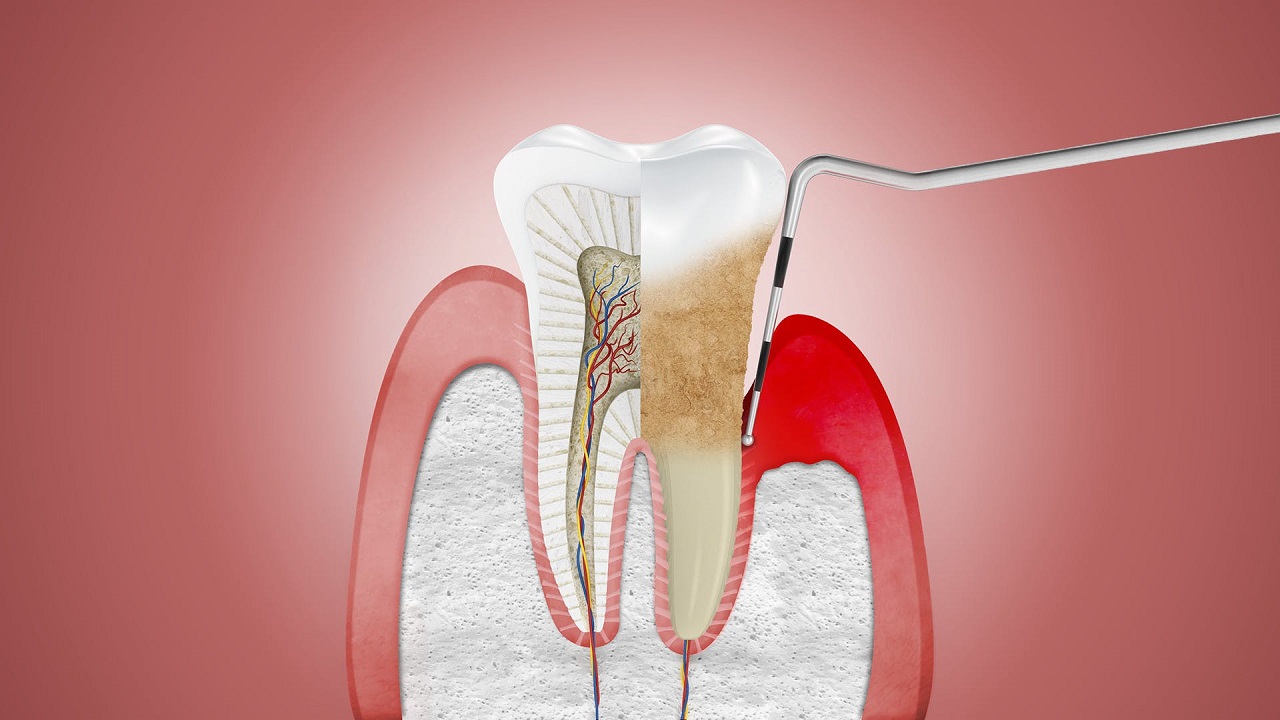 Hướng dẫn cách chữa viêm nha chu răng tại nhà hiệu quả và an toàn