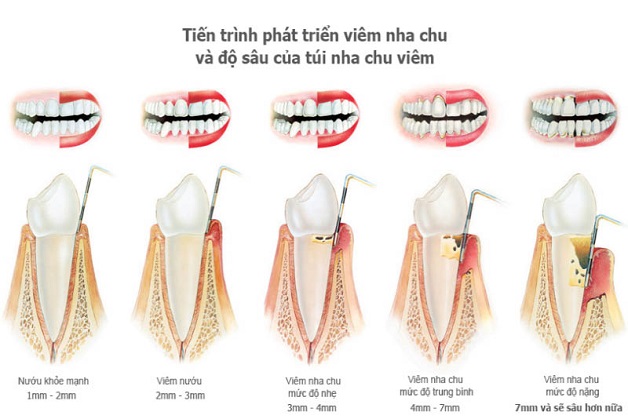 Quá trình phát triển của bệnh viêm nha chu 