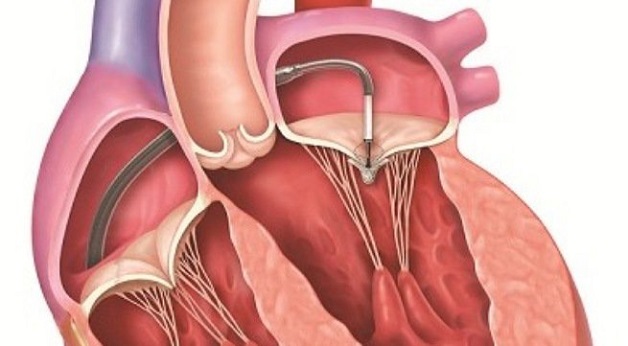 Can thiệp, phẫu thuật van tim là biện pháp cuối cùng khi bệnh hẹp van tim quá nặng, không thể chữa được
