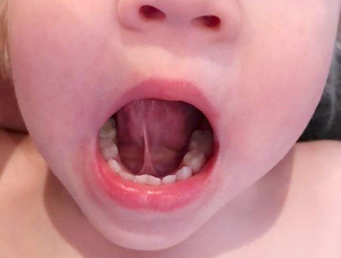 Dính thắng lưỡi là dị tật nhẹ ở trẻ cản trở quá trình ăn và học nói của trẻ