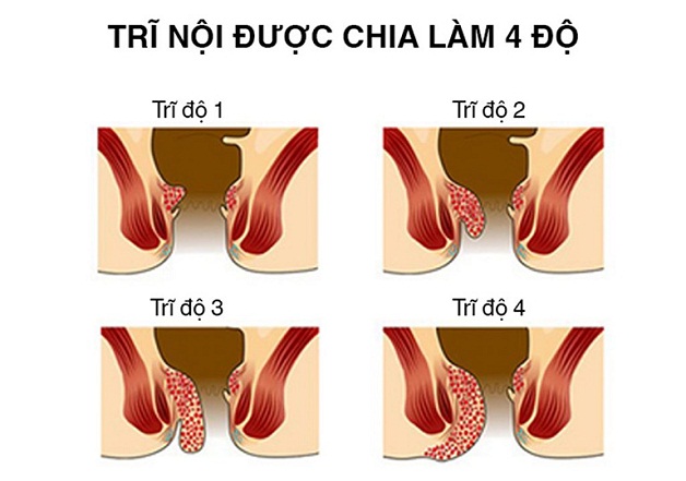 Cắt trĩ hết bao tiền phụ thuộc vào tình trạng sức khỏe và mức độ bệnh