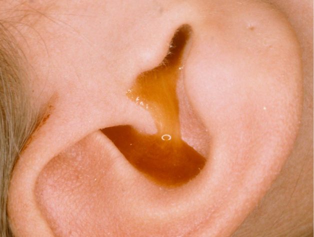 Viêm tai ngoài ở trẻ sơ sinh có thực sự nguy hiểm?