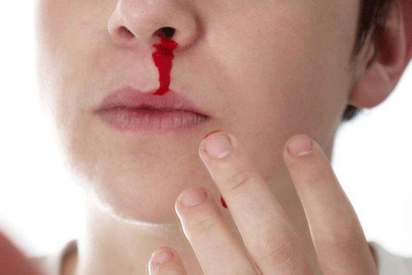 Bệnh nhân có hiện tượng chảy máu ở vùng mũi