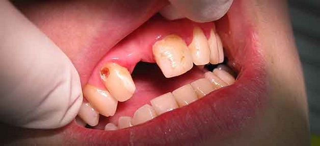 Nếu không điều trị sâu răng triệt để, nguy cơ mất răng sẽ rất cao