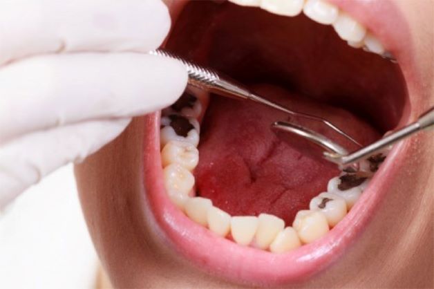 Những người bị sâu răng thường hay có cảm giác ê buốt, đau nhức vào buổi đêm