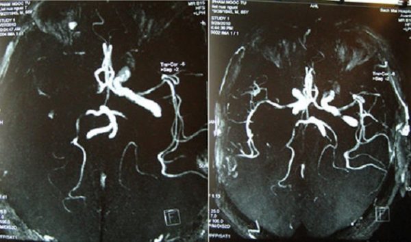 chụp MRI mạch máu não