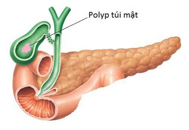 Có polyp ở túi mật là hiện tượng xuất hiện các u nhú phát triển trên niêm mạc thành túi mật