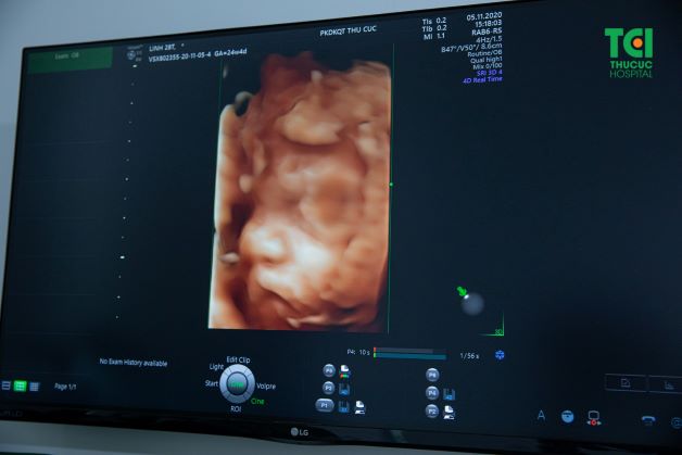 Siêu âm thai 5D giúp các mẹ bầu có thể quan sát một cách chân thực, rõ nét hình thái, cử động của thai nhi