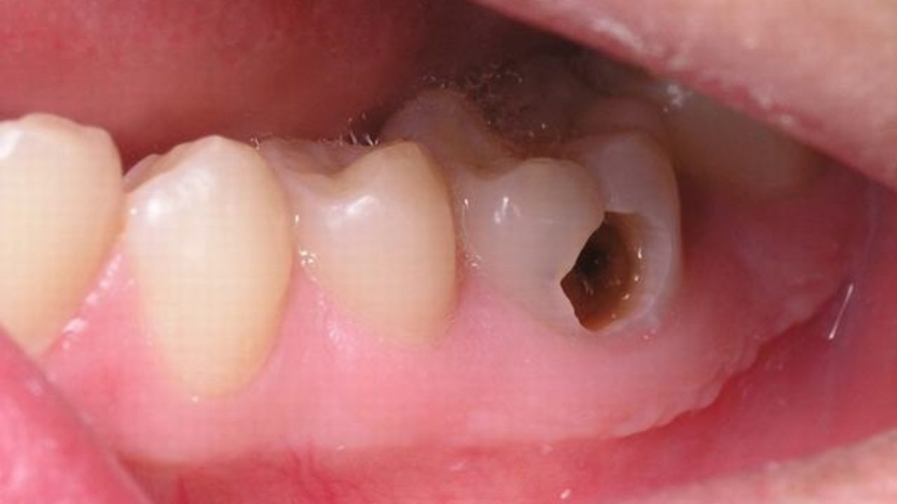 Nếu bị nhiễm trùng chân răng, cần điều trị như thế nào?

