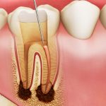 Diệt tủy răng có ảnh hưởng gì không?