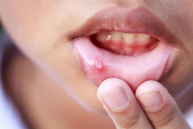 Viêm loét miệng là bệnh phát triển bên trong khoang miệng với một hoặc nhiều nốt mụn màu trắng kem.