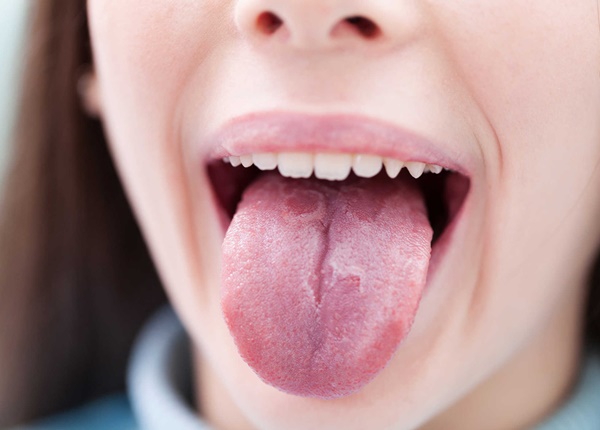 Nhiễm nấm candida ở khoang miệng có lẽ là bệnh lý nghiêm trọng nhất trong các bệnh lý ở khoang miệng.