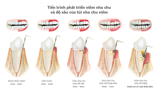 Để nhận biết các dấu hiệu của bệnh nha chu, chúng ta chỉ cần quan sát tình trạng của nướu.