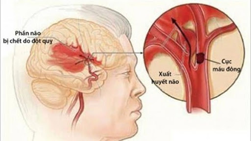 đột quỵ cấp