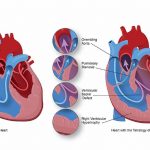 Hẹp van tim bẩm sinh: Nguyên nhân và triệu chứng 