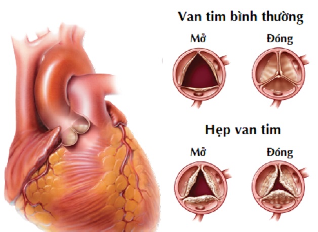 Hẹp van tim bẩm sinh: Nguyên nhân và triệu chứng | TCI Hospital