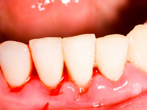 Hình ảnh viêm nướu răng giúp nhận biết dấu hiệu và cách điều trị
